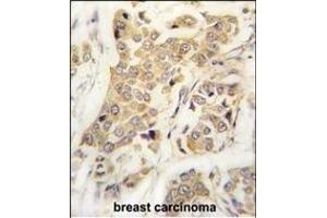 Formalin-fixed and paraffin-embedded human breast carcinoma tissue reacted with CDH8 antibody (N-term) (ABIN388149 and ABIN2846895) , which was peroxidase-conjugated to the secondary antibody, followed by DAB staining. (Cadherin 8 Antikörper  (N-Term))