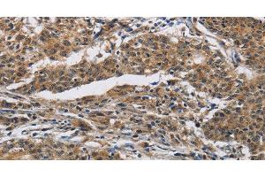 Immunohistochemistry of paraffin-embedded Human gastric cancer using IFNGR2 Polyclonal Antibody at dilution of 1:40 (IFNGR2 Antikörper)