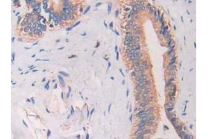 DAB staining on IHC-P; Samples: Human Bile duct cancer Tissue