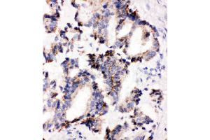 Anti-IRAK2 antibody, IHC(P) IHC(P): Human Lung Cancer Tissue