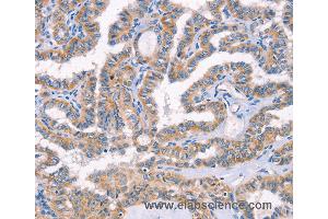 Immunohistochemistry of Human lung cancer using AP1B1 Polyclonal Antibody at dilution of 1:70