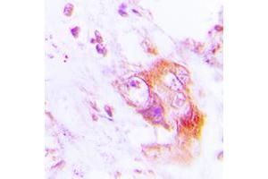 Immunohistochemical analysis of PKR (pT451) staining in human lung cancer formalin fixed paraffin embedded tissue section. (EIF2AK2 Antikörper  (C-Term, pSer451))