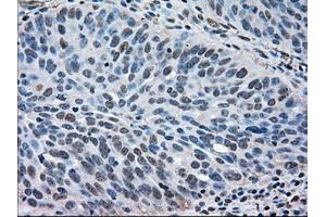 Immunohistochemical staining of paraffin-embedded Adenocarcinoma of breast tissue using anti-MAPK1 mouse monoclonal antibody. (ERK2 Antikörper)