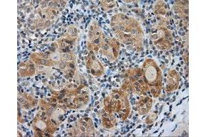 Immunohistochemical staining of paraffin-embedded Adenocarcinoma of colon tissue using anti-LIPG mouse monoclonal antibody. (LIPG Antikörper)