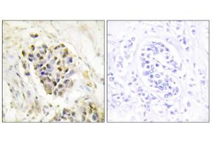 Immunohistochemistry analysis of paraffin-embedded human breast carcinoma tissue using MED1 antibody. (MED1 Antikörper  (Internal Region))