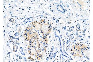 ABIN6257207 and ABIN6275954 at 1/100 staining Human pancreatic cancer by IHC-P.