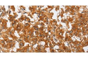 Immunohistochemistry of paraffin-embedded Human thyroid cancer using cPLA2 Polyclonal Antibody at dilution of 1:50 (PLA2G4A Antikörper)
