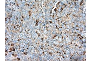 Immunohistochemical staining of paraffin-embedded Adenocarcinoma of colon tissue using anti-ALDH3A1 mouse monoclonal antibody. (ALDH3A1 Antikörper)