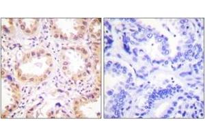 Immunohistochemistry analysis of paraffin-embedded human lung carcinoma tissue, using NEDD8 Antibody. (NEDD8 Antikörper  (AA 10-59))