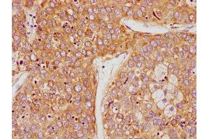 IHC image of ABIN7164243 diluted at 1:100 and staining in paraffin-embedded human liver cancer performed on a Leica BondTM system. (PSG9 Antikörper  (AA 241-426))