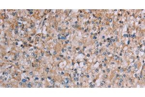Immunohistochemistry of paraffin-embedded Human prostate cancer tissue using PLXNA4 Polyclonal Antibody at dilution 1:50 (Plexin A4 Antikörper)