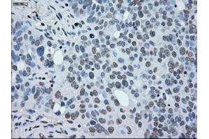 Immunohistochemical staining of paraffin-embedded Adenocarcinoma of breast tissue using anti-MAP2K2 mouse monoclonal antibody. (MEK2 Antikörper)