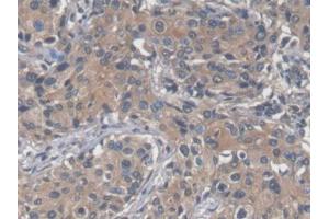 DAB staining on IHC-P; Samples: Human Prostate cancer Tissue (SAA Antikörper  (AA 19-122))