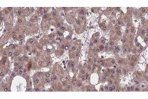 ABIN6277524 at 1/100 staining Human liver cancer tissue by IHC-P.