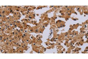 Immunohistochemistry of paraffin-embedded Human prostate cancer tissue using IFRD1 Polyclonal Antibody at dilution 1:40