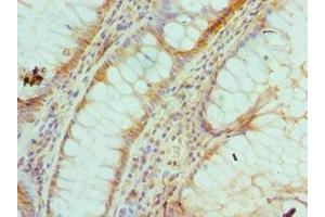 Immunohistochemistry of paraffin-embedded human colon cancer using ABIN7142923 at dilution of 1:100
