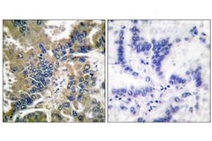 Immunohistochemical analysis of paraffin-embedded human lung carcinoma tissue, using Caspase 1 (Cleaved-Asp210) antibody (ABIN5978453). (Caspase 1 Antikörper  (Cleaved-Asp210, Internal Region))