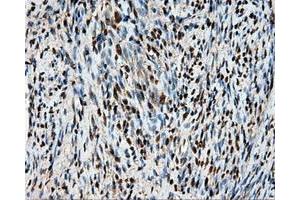 Immunohistochemical staining of paraffin-embedded Adenocarcinoma of ovary tissue using anti-HSPA1A mouse monoclonal antibody. (HSP70 1A Antikörper)