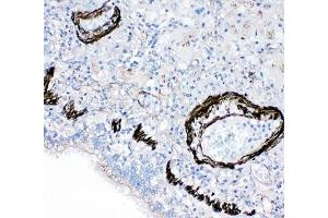 IHC-P: FABP6 antibody testing of human lung cancer tissue (FABP6 Antikörper  (N-Term))