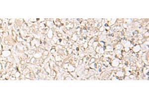 Immunohistochemistry of paraffin-embedded Human ovarian cancer tissue using IGHA1 Polyclonal Antibody at dilution of 1:65(x200) (IGHA1 Antikörper)