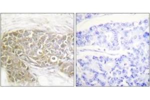 Immunohistochemistry analysis of paraffin-embedded human breast carcinoma tissue, using PEA-15 (Ab-116) Antibody. (PEA15 Antikörper  (AA 81-130))