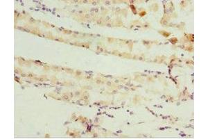 Immunohistochemistry of paraffin-embedded human gastric cancer using ABIN7158947 at dilution of 1:100 (GSTZ1 Antikörper  (AA 1-216))
