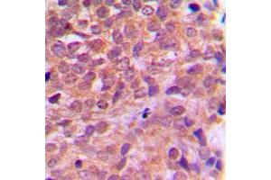 Immunohistochemical analysis of AMPK beta 1 staining in human breast cancer formalin fixed paraffin embedded tissue section. (PRKAB1 Antikörper  (N-Term))