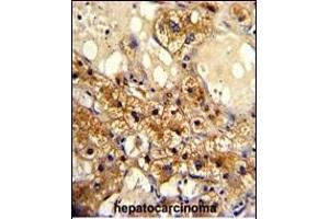 Formalin-fixed and paraffin-embedded human hepatocarcinoma with CYP20A1 Antibody (C-term), which was peroxidase-conjugated to the secondary antibody, followed by DAB staining. (CYP20A1 Antikörper  (C-Term))