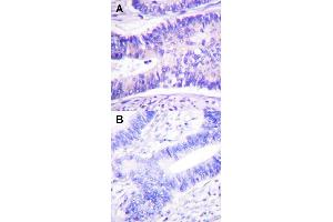 Immunohistochemical staining (Formalin-fixed paraffin-embedded sections) of human colon carcinoma tissue with WASF1 (phospho Y125) polyclonal antibody  under 1:50-1:100 dilution (A) or treated with synthesized peptide (B). (WASF1 Antikörper  (pTyr125))