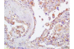 Formalin-fixed and paraffin embedded human lung carcinoma  labeled with Rabbit Anti-CD44 Polyclonal Antibody (ABIN669591) at 1:200 followed by conjugation to the secondary antibody and DAB staining (CD44 Antikörper  (AA 701-742))