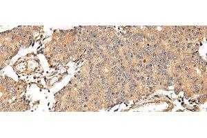 Immunohistochemistry of paraffin-embedded Human prostate cancer using ALDH3A2 Polyclonal Antibody at dilution of 1/20 (ALDH3A2 Antikörper)