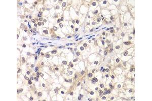 Immunohistochemistry of paraffin-embedded Human kidney cancer using USF1 Polyclonal Antibody at dilution of 1:200 (40x lens). (USF1 Antikörper)