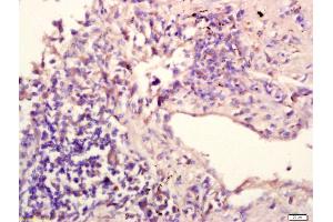 Formalin-fixed and paraffin embedded human lung carcinoma labeled with Anti-IL-12RB1/CD212 Polyclonal Antibody, Unconjugated (ABIN747863) at 1:200 followed by conjugation to the secondary antibody and DAB staining