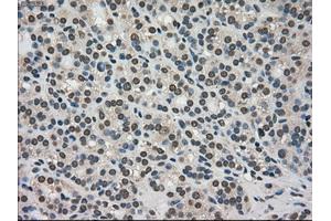 Immunohistochemical staining of paraffin-embedded Adenocarcinoma of colon tissue using anti-TRIB2mouse monoclonal antibody. (TRIB2 Antikörper)