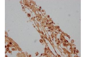 IHC image of ABIN7157890 diluted at 1:100 and staining in paraffin-embedded human melanoma cancer performed on a Leica BondTM system. (LAMb4 Antikörper  (AA 1513-1761))