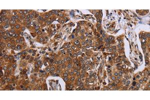 Immunohistochemistry of paraffin-embedded Human liver cancer using ACP6 Polyclonal Antibody at dilution of 1:30 (ACP6 Antikörper)