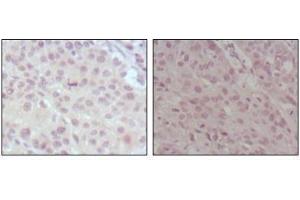 Immunohistochemical analysis of paraffin-embedded human lung cancer (left) and esophagus cancer (right), showing nuclear weak staining with DAB staining using MLL antibody. (MLL/KMT2A Antikörper  (AA 3751-3968))