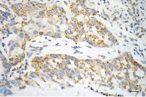 Immunohistochemistry was performed on paraffin-embedded human hepatocarcinoma using ACAT1 antibody (ABIN7797438), 1:200). (ACAT1 Antikörper)