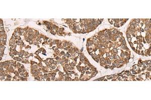 Immunohistochemistry of paraffin-embedded Human esophagus cancer tissue using CAD Polyclonal Antibody at dilution of 1:50(x200) (CAD Antikörper)