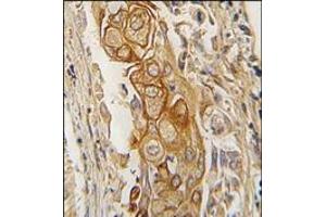 Formalin-fixed and paraffin-embedded human lung carcinoma tissue reacted with ACPP antibody (C-term), which was peroxidase-conjugated to the secondary antibody, followed by DAB staining. (ACPP Antikörper  (C-Term))