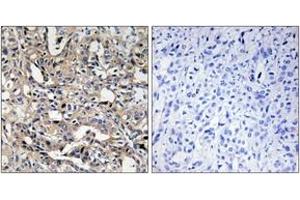 Immunohistochemistry analysis of paraffin-embedded human liver carcinoma, using BAX Antibody. (BAX Antikörper  (AA 10-59))