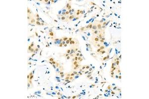 Immunohistochemistry of paraffin embedded human breast cancer using Suv39h2 (ABIN7075771) at dilution of 1:2000 (400x lens) (SUV39H2 Antikörper)
