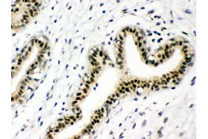 Anti-p95 NBS1 Picoband antibody, IHC(P) IHC(P): Human Mammary Cancer Tissue (Nibrin Antikörper  (C-Term))