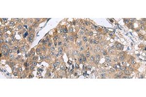 Immunohistochemistry of paraffin-embedded Human liver cancer tissue using RPL18 Polyclonal Antibody at dilution of 1:70(x200) (RPL18 Antikörper)