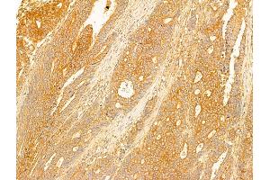 ABIN6263515 and ABIN6273059 at 1/100 staining Human colorectal cancer by IHC-P.