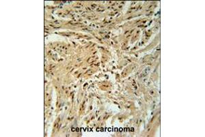 BLOC1S2 Antibody immunohistochemistry analysis in formalin fixed and paraffin embedded human cervix carcinoma followed by peroxidase conjugation of the secondary antibody and DAB staining. (BLOC1S2 Antikörper  (AA 14-40))