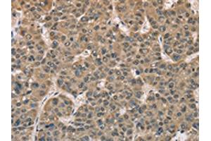 The image on the left is immunohistochemistry of paraffin-embedded Human liver cancer tissue using ABIN7129149(DACH2 Antibody) at dilution 1/40, on the right is treated with fusion protein. (DACH2 Antikörper)