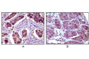 Immunohistochemical analysis of paraffin-embedded human breast carcinoma (A) and liver carcinoma (B), showing cytoplasmic localization using BCL10 antibody with DAB staining. (BCL10 Antikörper)