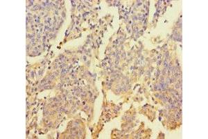 Immunohistochemistry of paraffin-embedded human cervical cancer using ABIN7176469 at dilution of 1:100 (ZNF662 Antikörper  (AA 182-452))