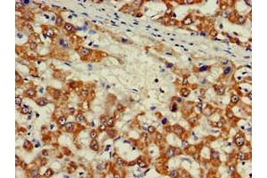 Immunohistochemistry of paraffin-embedded human liver cancer using ABIN7176539 at dilution of 1:100 (Zinc Finger Protein 816A (ZNF816A) (AA 1-200) Antikörper)